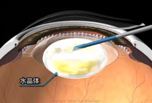 白内障手術の説明イラスト