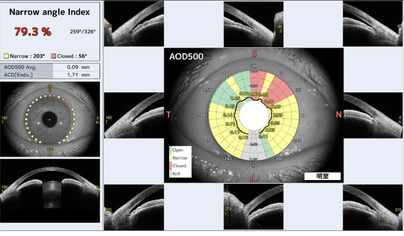 手術症例集 – 望月眼科 浄水通り院 | 福岡市中央区薬院 | 多焦点レンズ