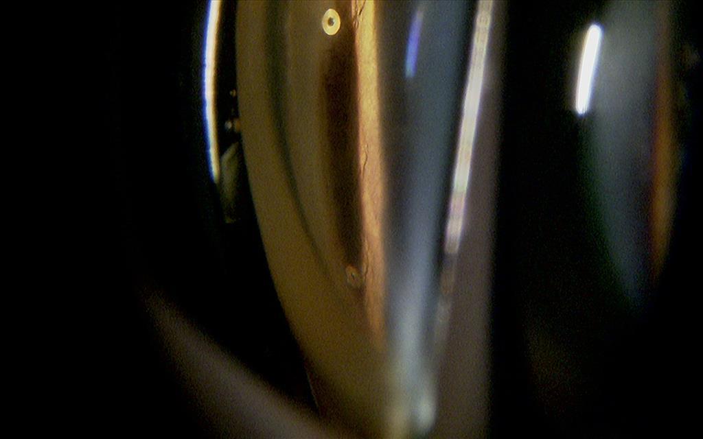 アイステント手術の様子