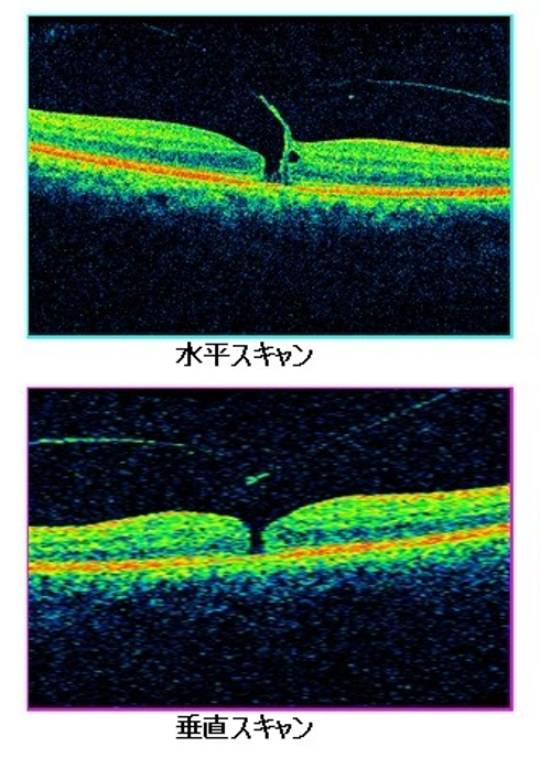 症例2術前画像
