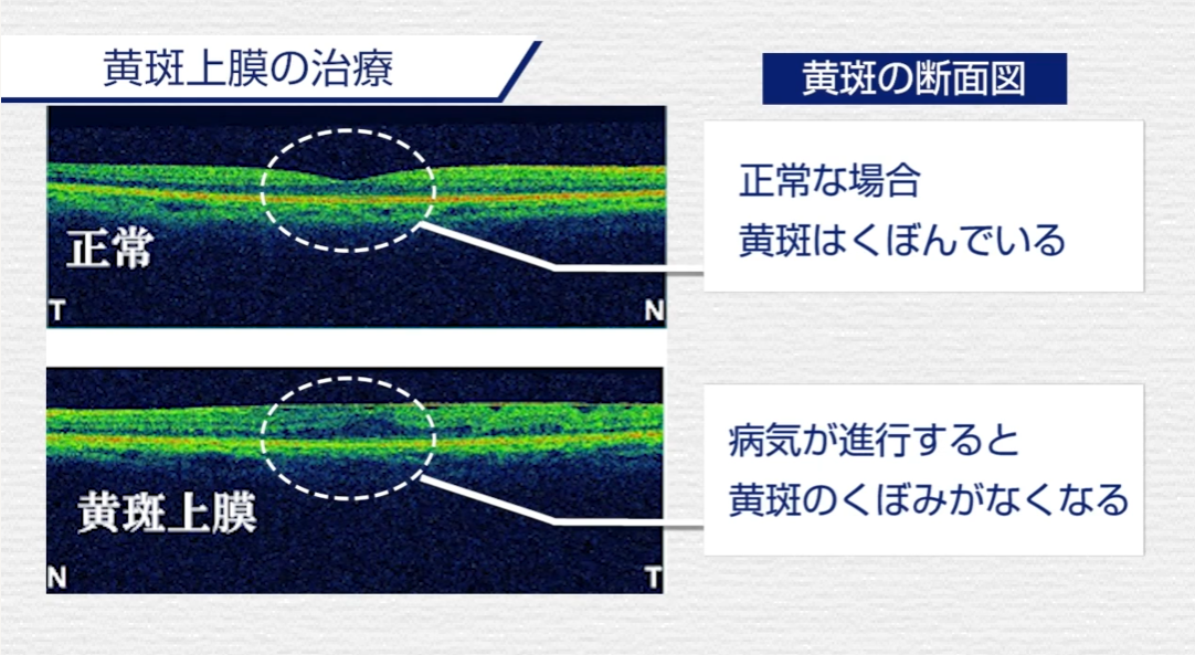 黄斑上膜の図解
