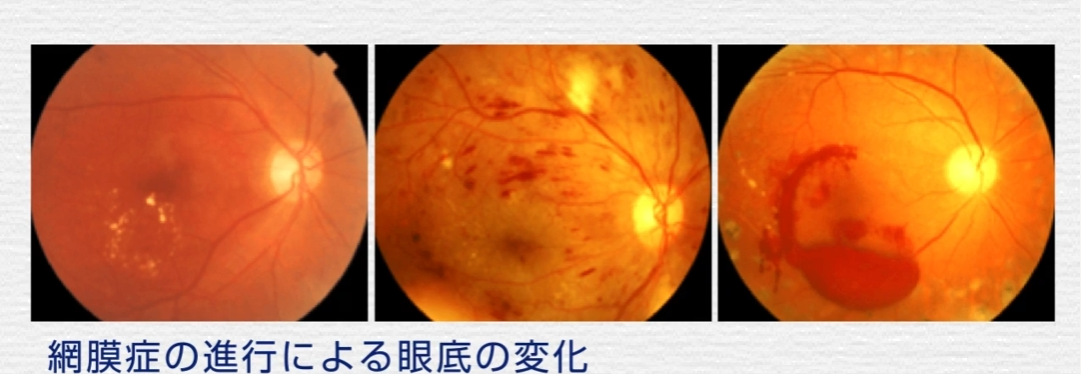 糖尿病網膜症の図解
