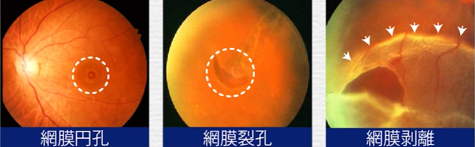 網膜剥離の図解