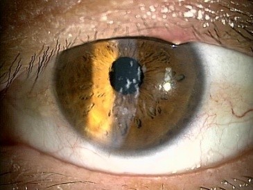 左眼
